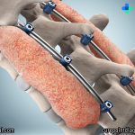Spine Surgery Best Types, Quick Recovery & Lasting Relief