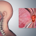 Throat Cancer Symptoms: Early Warning Signs, Risks & Treatment Guide