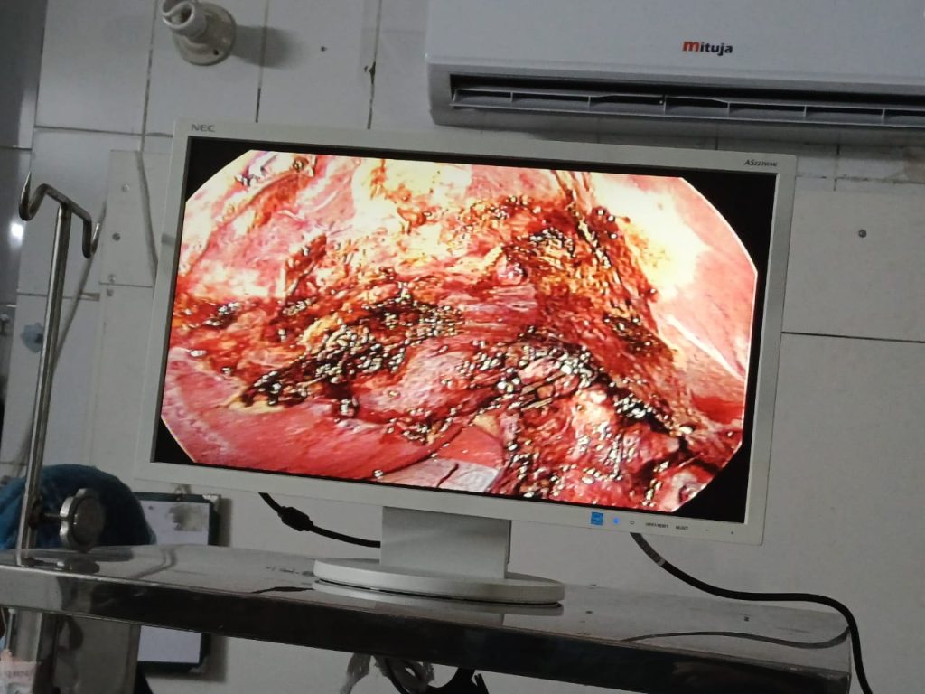 Gallbladder Operation - Dr. Mohammad Abdullah Al Mamun