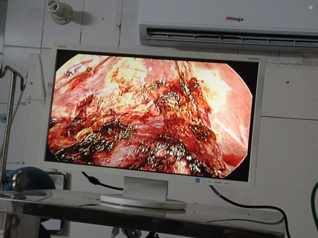 Gallbladder Operation - Dr. Mohammad Abdullah Al Mamun