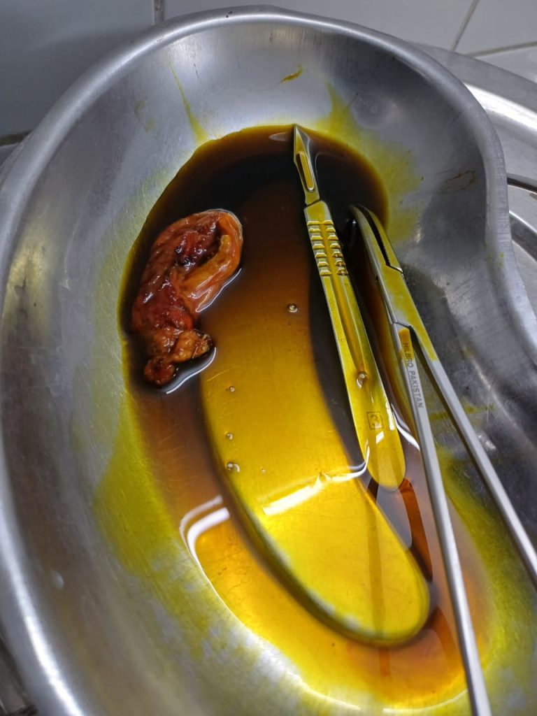 Gallbladder Operation - Dr. Mohammad Abdullah Al Mamun