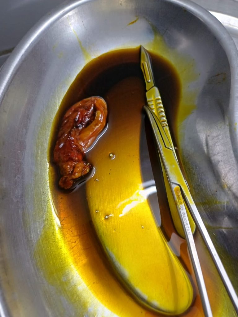 Gallbladder Operation - Dr. Mohammad Abdullah Al Mamun