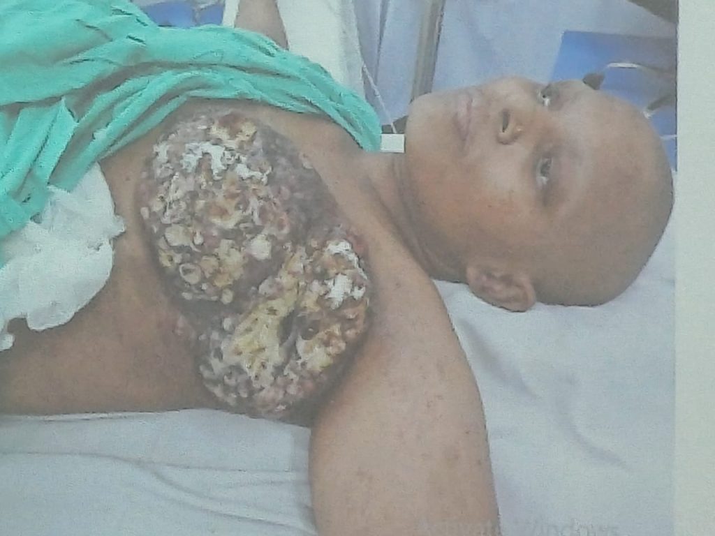 Breast Cancer Late Stage - Assistant Professor Dr. Mohammad Abdullah Al Mamun