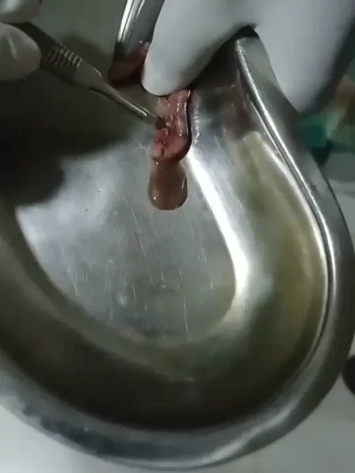 Laposcopic Appendectomy at Kingstone Hospital, Mirpur-12 | Dr. Mohammad Abdullah Al Mamun - 11/11/2025 ​