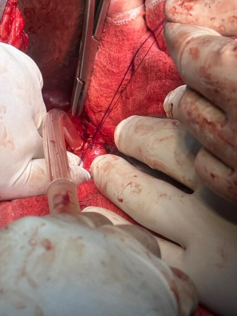 Liver Surgery - Assistant Professor Dr. Mohammad Abdullah Al Mamun