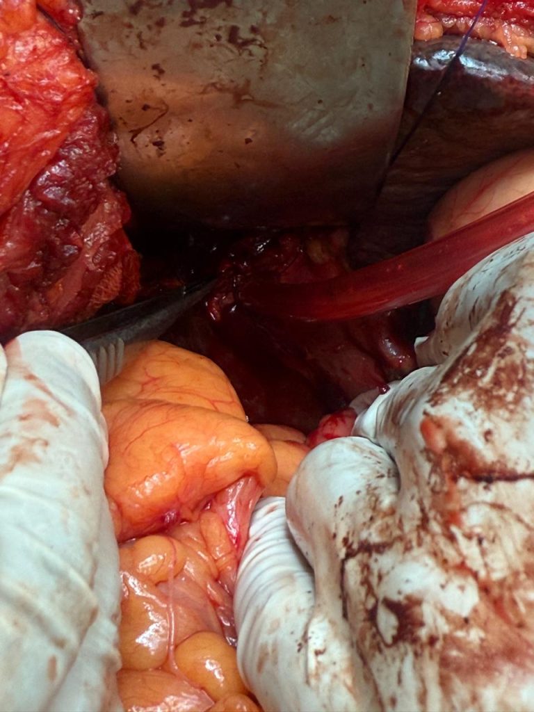 Liver Surgery - Assistant Professor Dr. Mohammad Abdullah Al Mamun