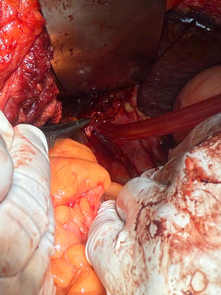 Liver Surgery - Assistant Professor Dr. Mohammad Abdullah Al Mamun