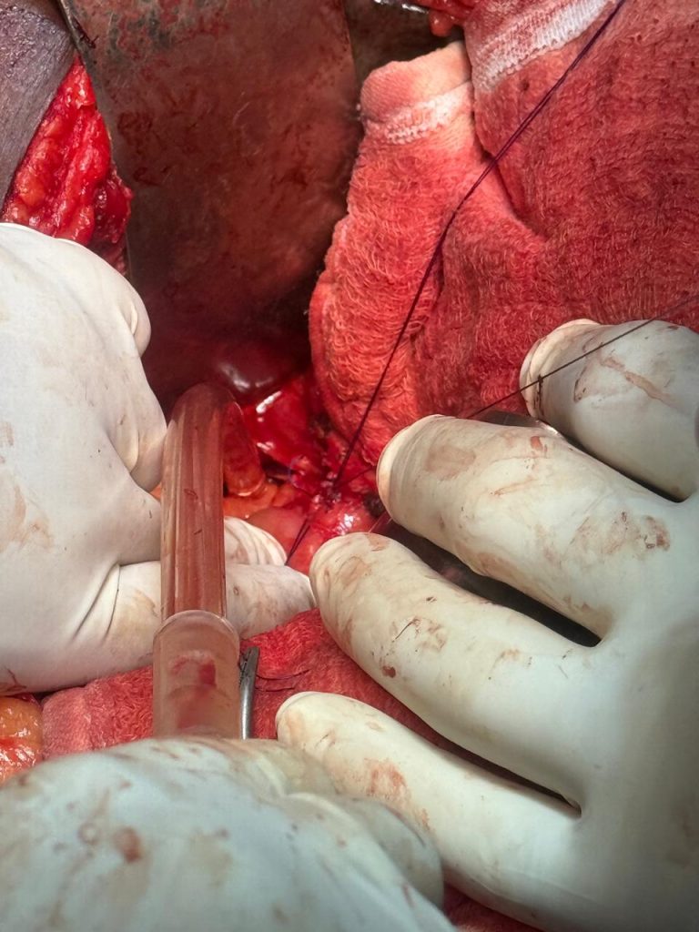 Liver Surgery - Assistant Professor Dr. Mohammad Abdullah Al Mamun