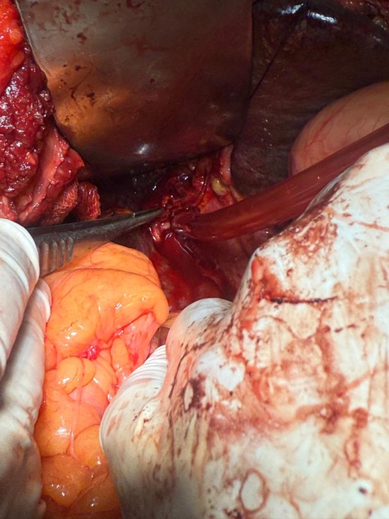 Liver Surgery - Assistant Professor Dr. Mohammad Abdullah Al Mamun