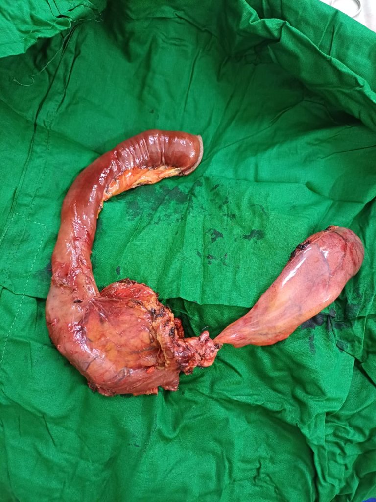 Whipple's Operation (9 hours big surgery) - National Institute of Cancer Research & Hospital (NICRH) - 05/11/2025 - Assistant Professor Dr. Mohammad Abdullah Al Mamun