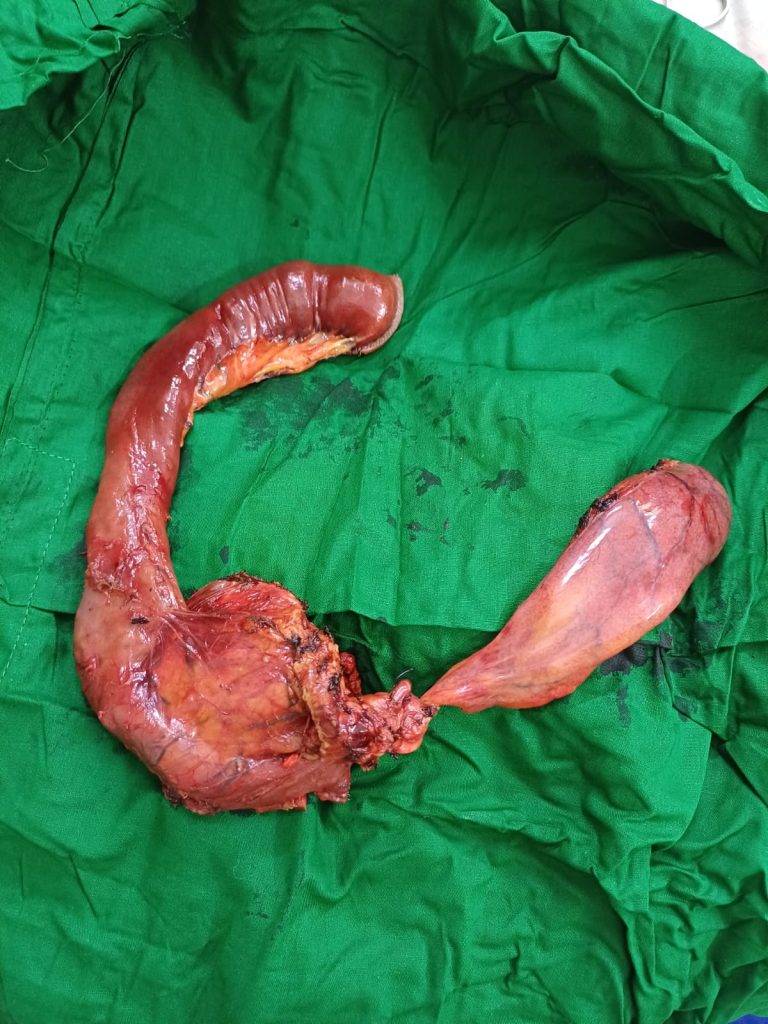 Whipple's Operation (9 hours big surgery) - National Institute of Cancer Research & Hospital (NICRH) - 05/11/2025 - Assistant Professor Dr. Mohammad Abdullah Al Mamun