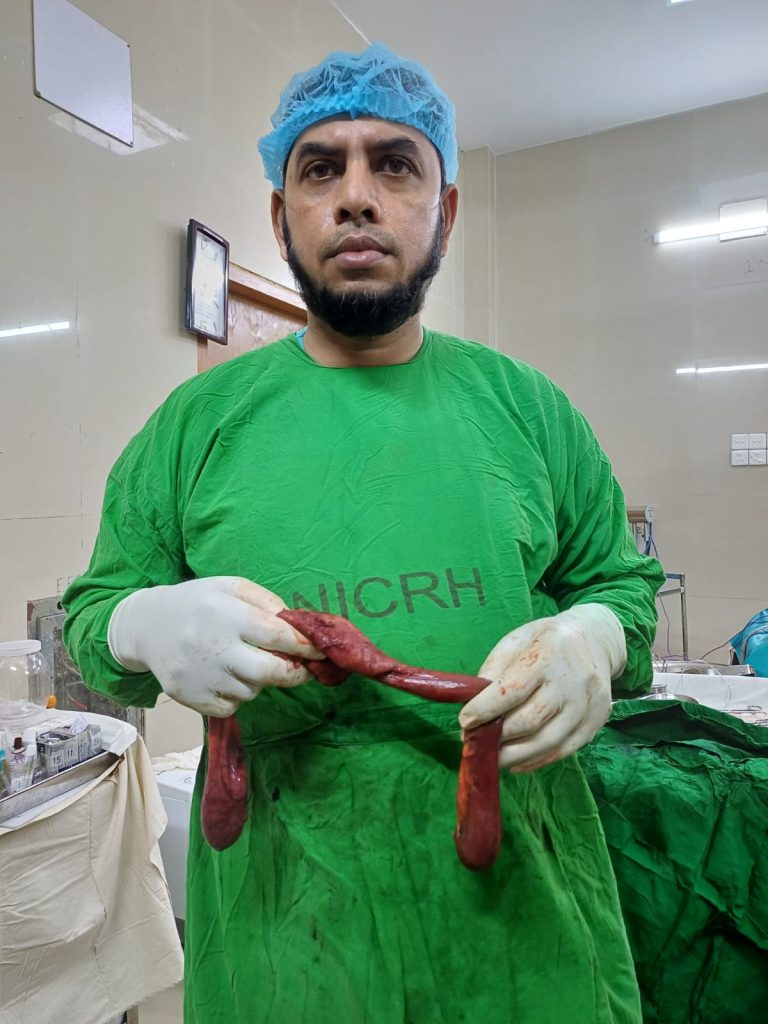 Whipple's Operation (9 hours big surgery) - National Institute of Cancer Research & Hospital (NICRH) - 05/11/2025 - Assistant Professor Dr. Mohammad Abdullah Al Mamun